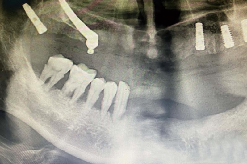 諾雅口腔醫院孔院長為上頜牙槽骨嚴重不足患者行穿顴穿翼植體植入手術